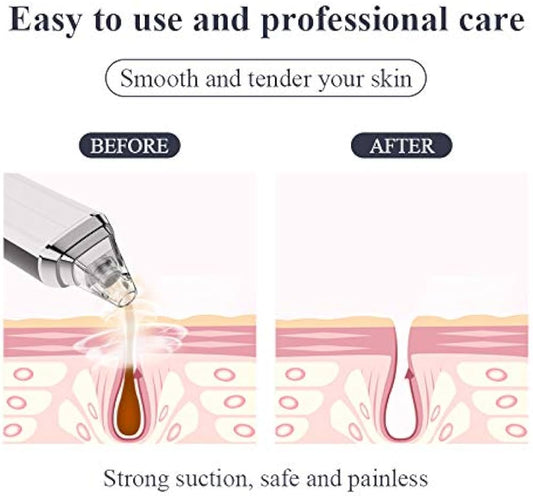 Blackhead Remover Vacuum – Powerful & Painless