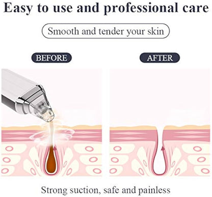 Blackhead Remover Vacuum – Powerful & Painless