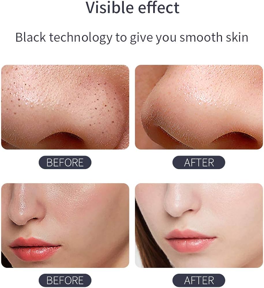 Blackhead Remover Vacuum – Powerful & Painless